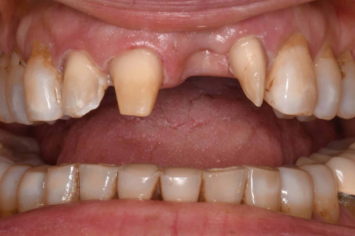 Smile before zirconia bridge