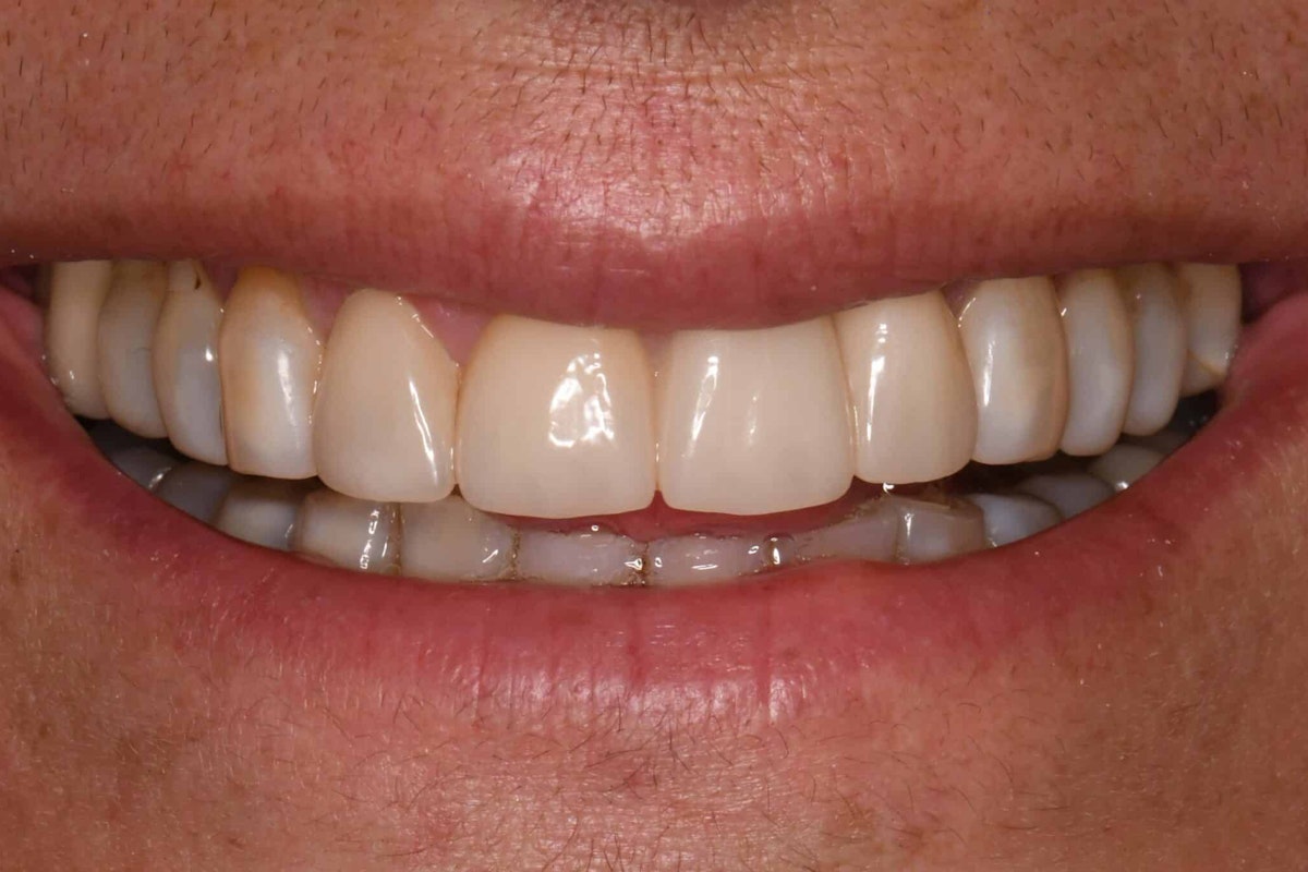 Smile after zirconia bridge