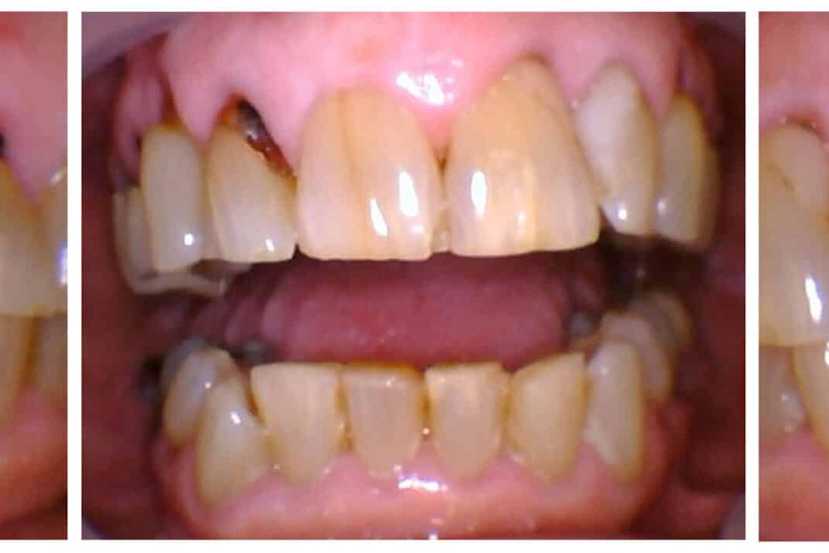 Smile before implant hybrid denture