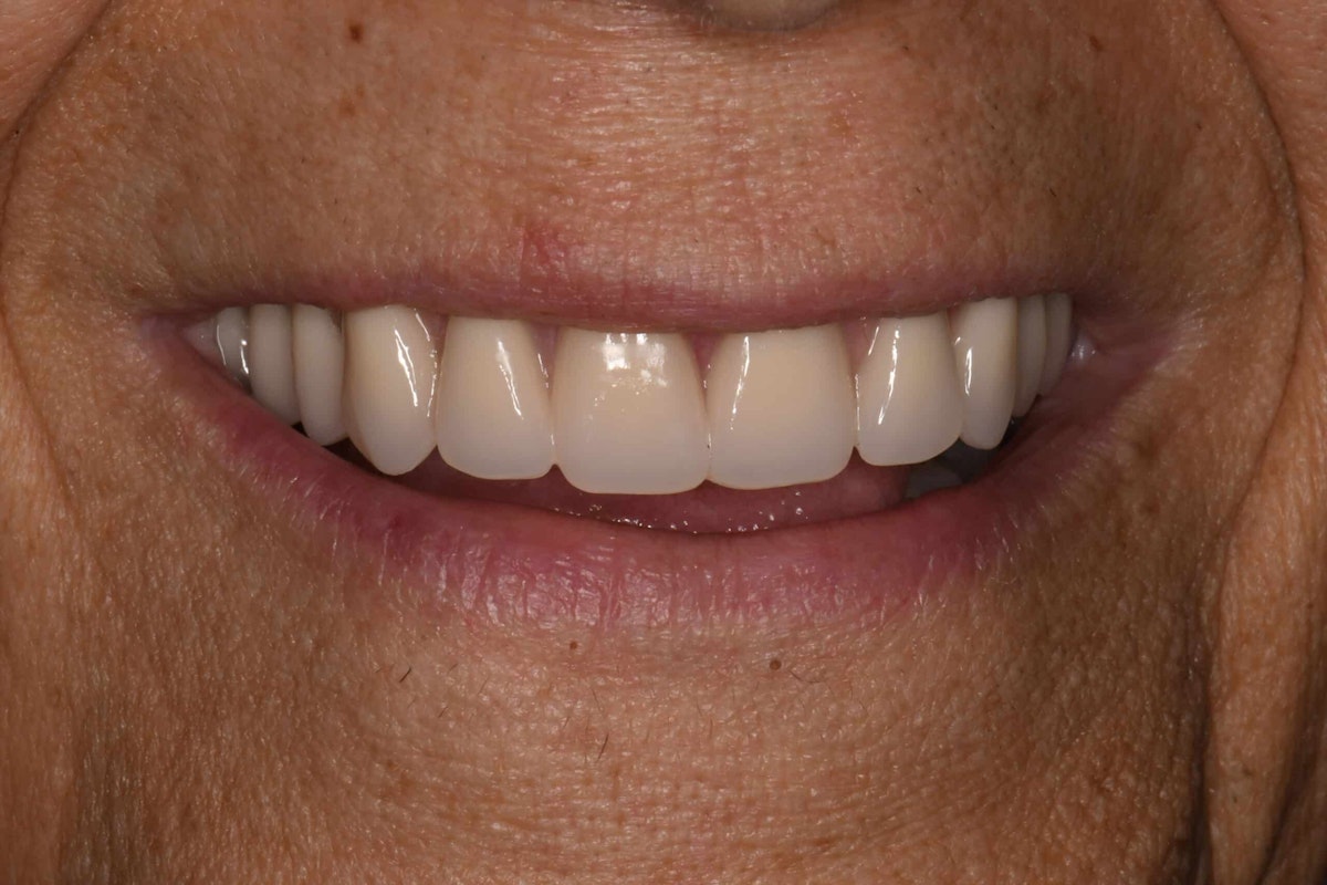 Smile after implant hybrid denture