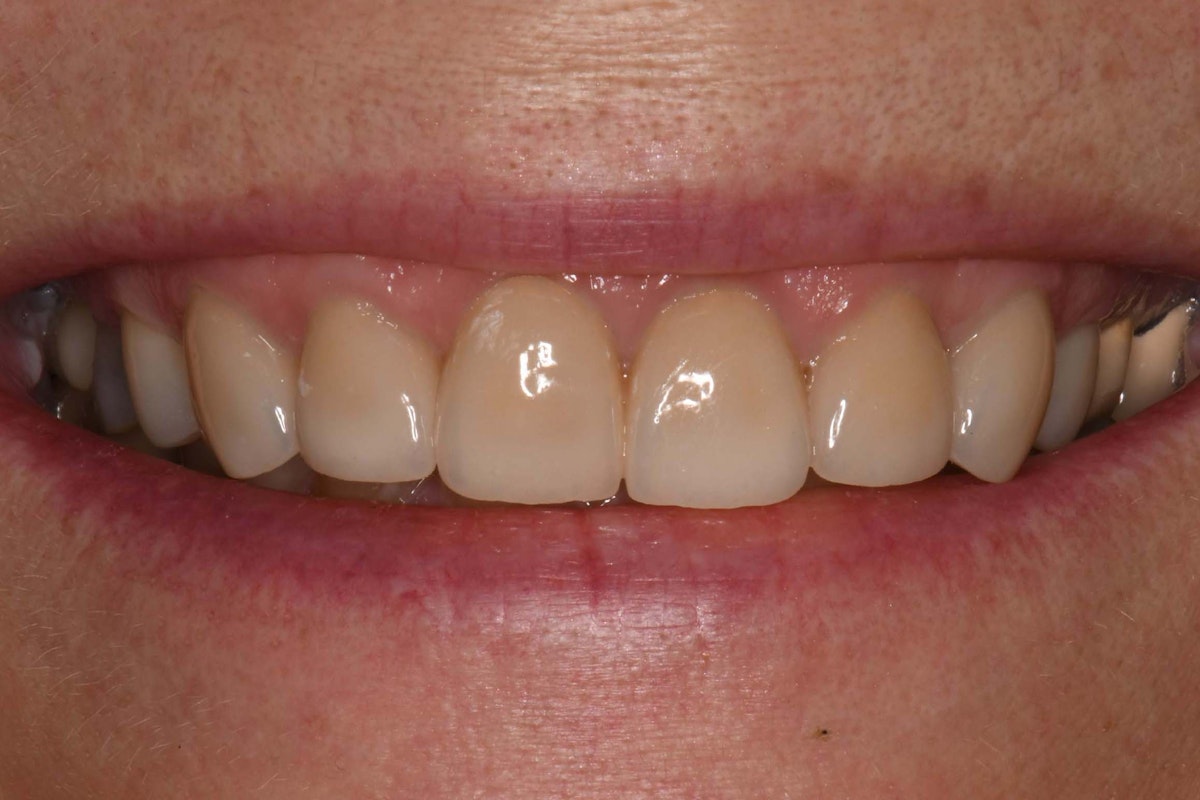 cb veneer after