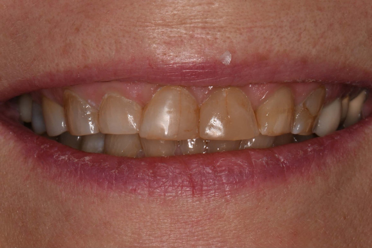 cb veneer before