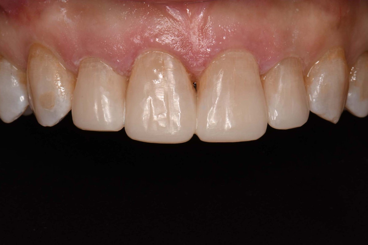 Composite Veneers After