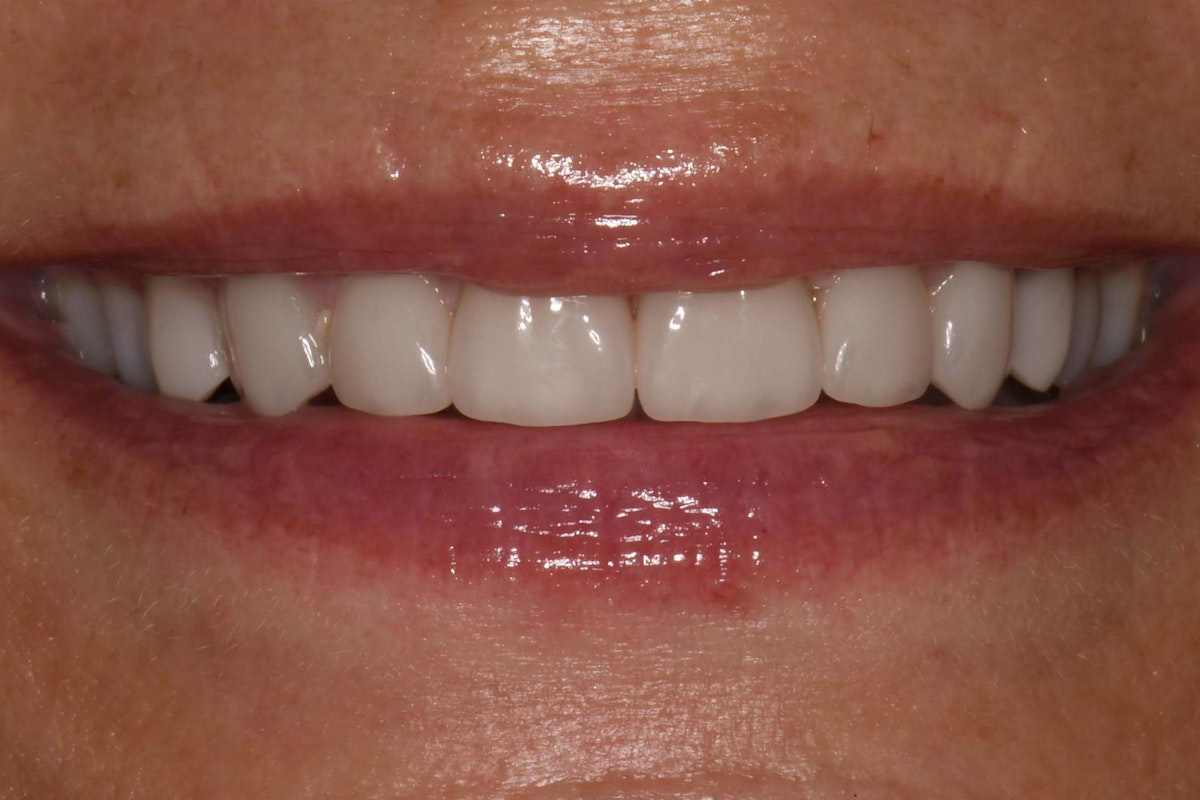 CJ Veneer After