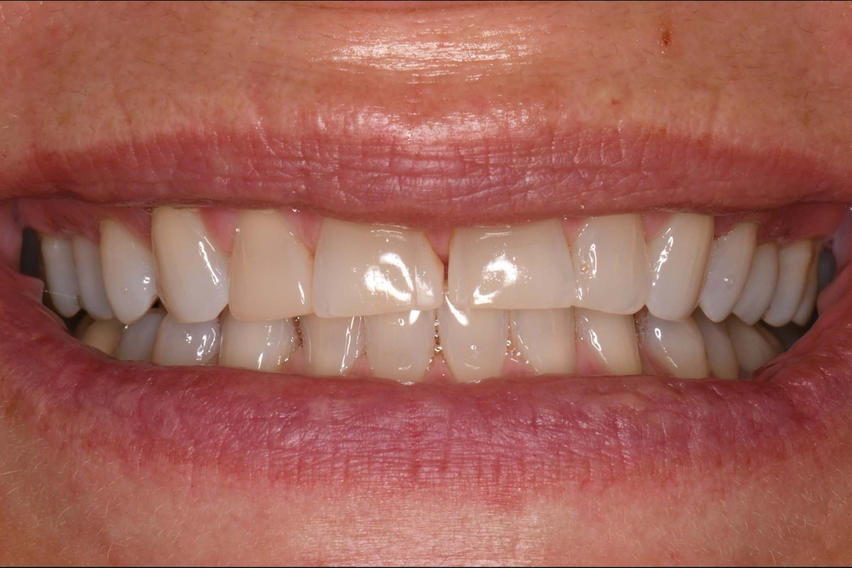 CJ Veneer Before