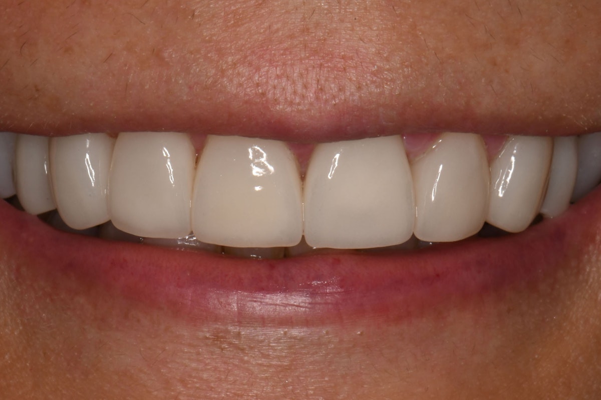 MB Veneer after
