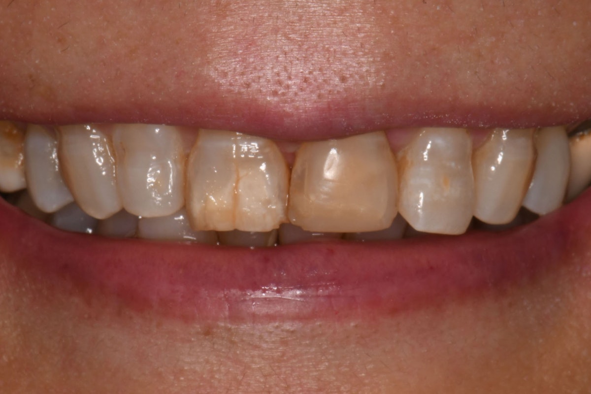 MB Veneer before