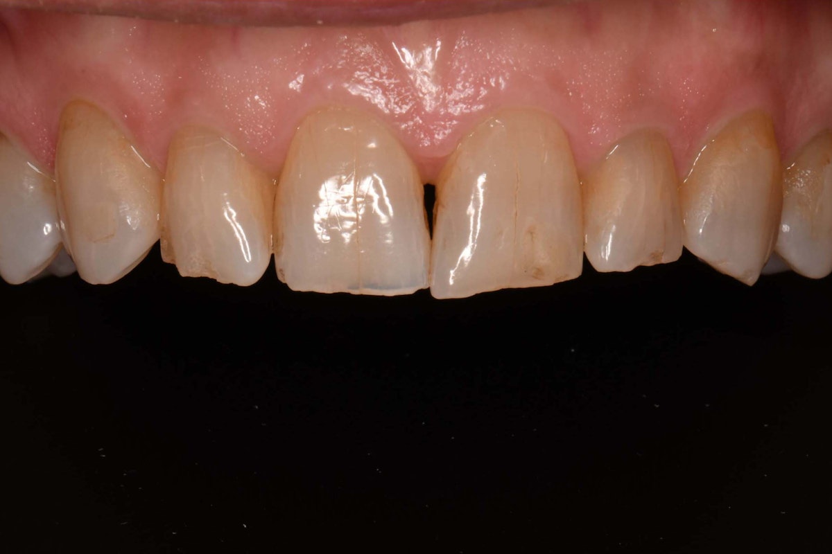 Composite Veneers Before
