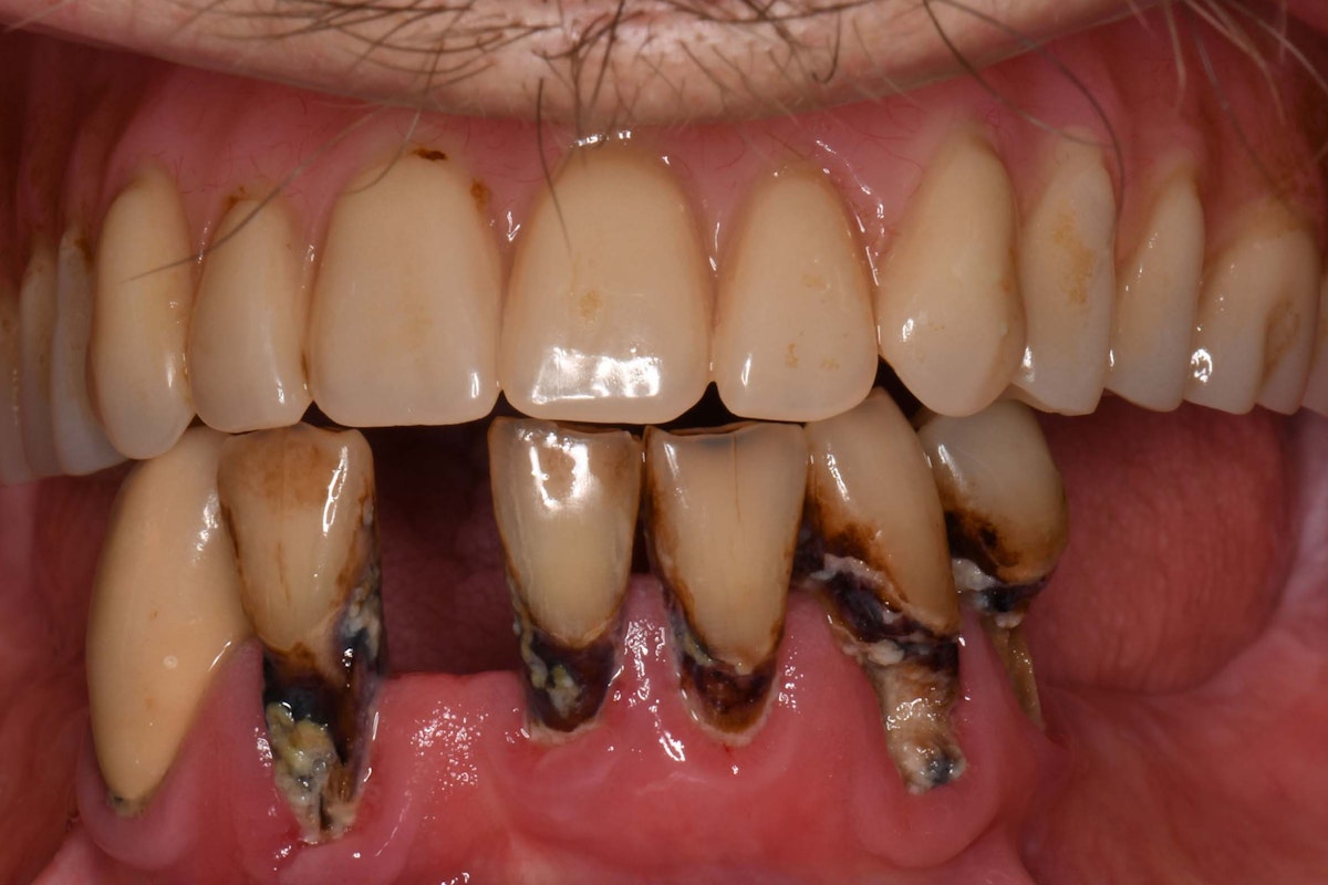 Max Man Hybrid Before