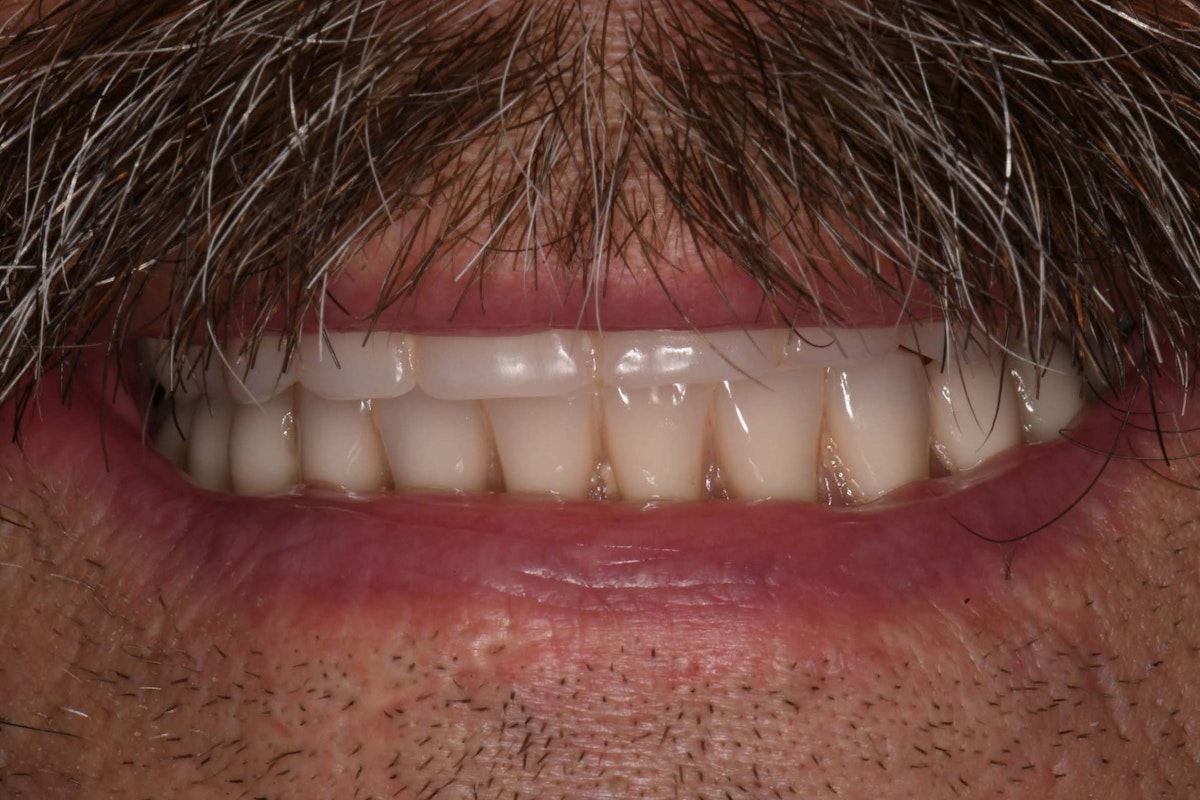 Max Man Hybrid After