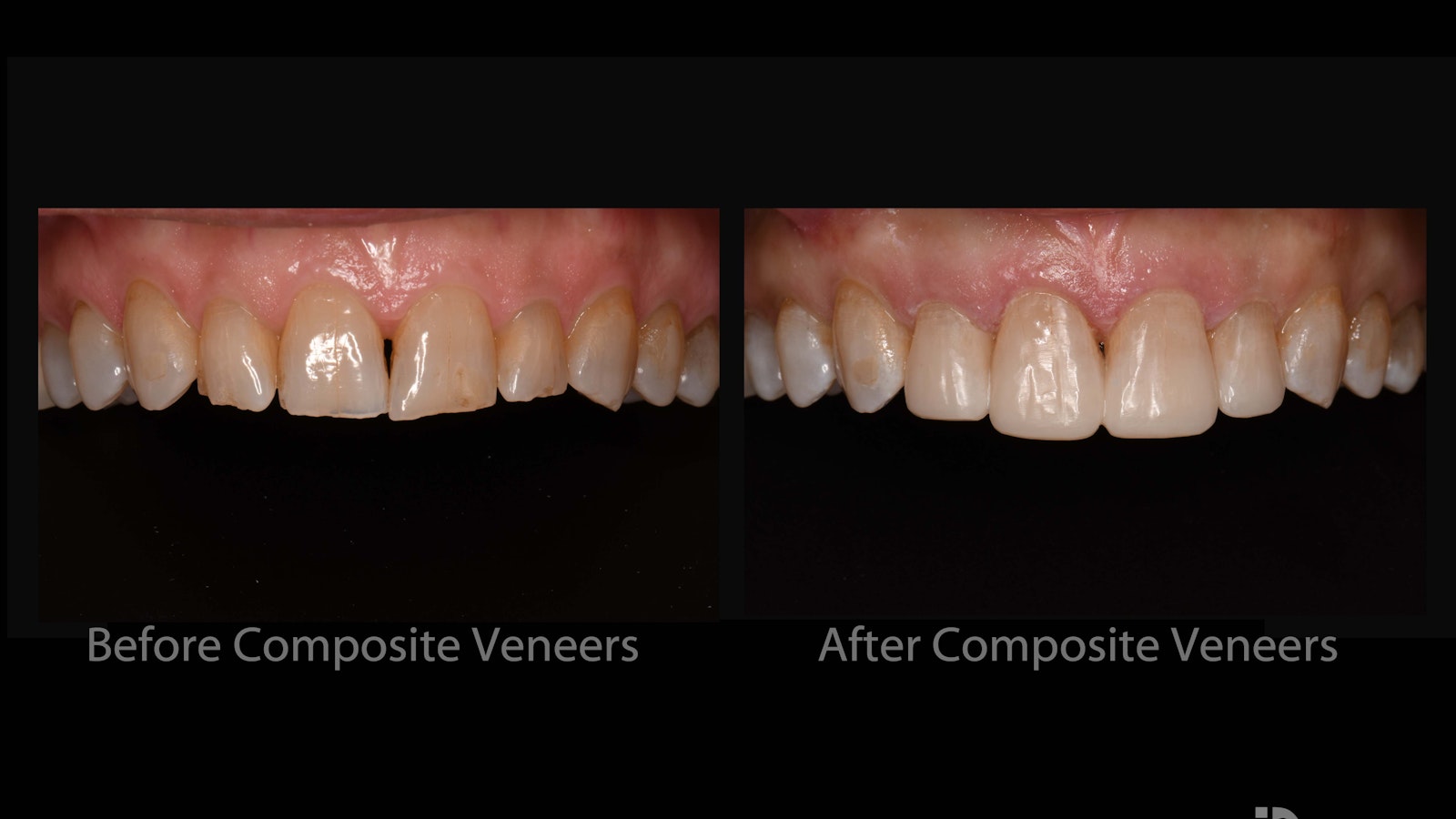 Composite Bonding