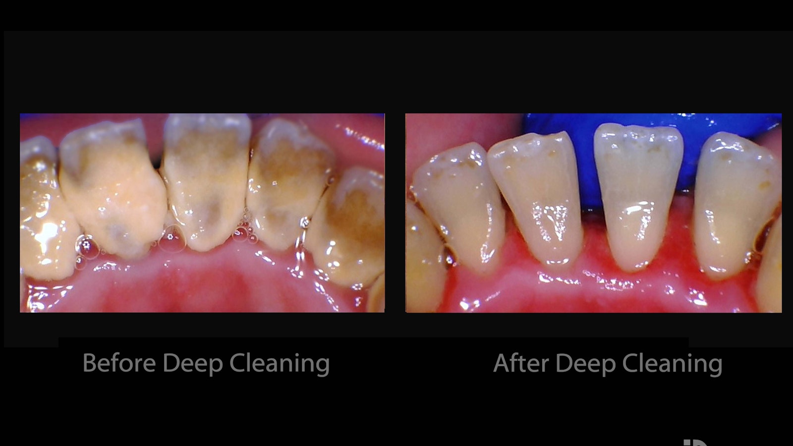 deep cleaning