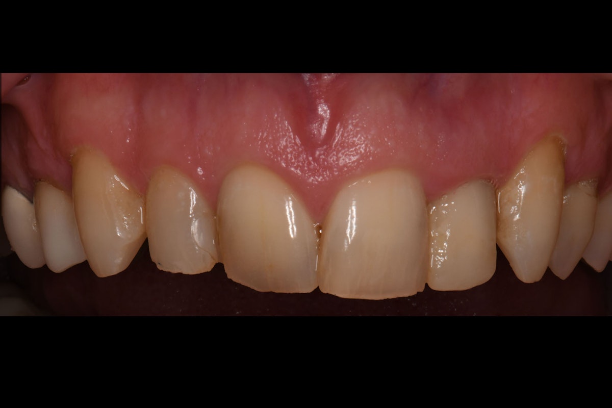 CF before crowns