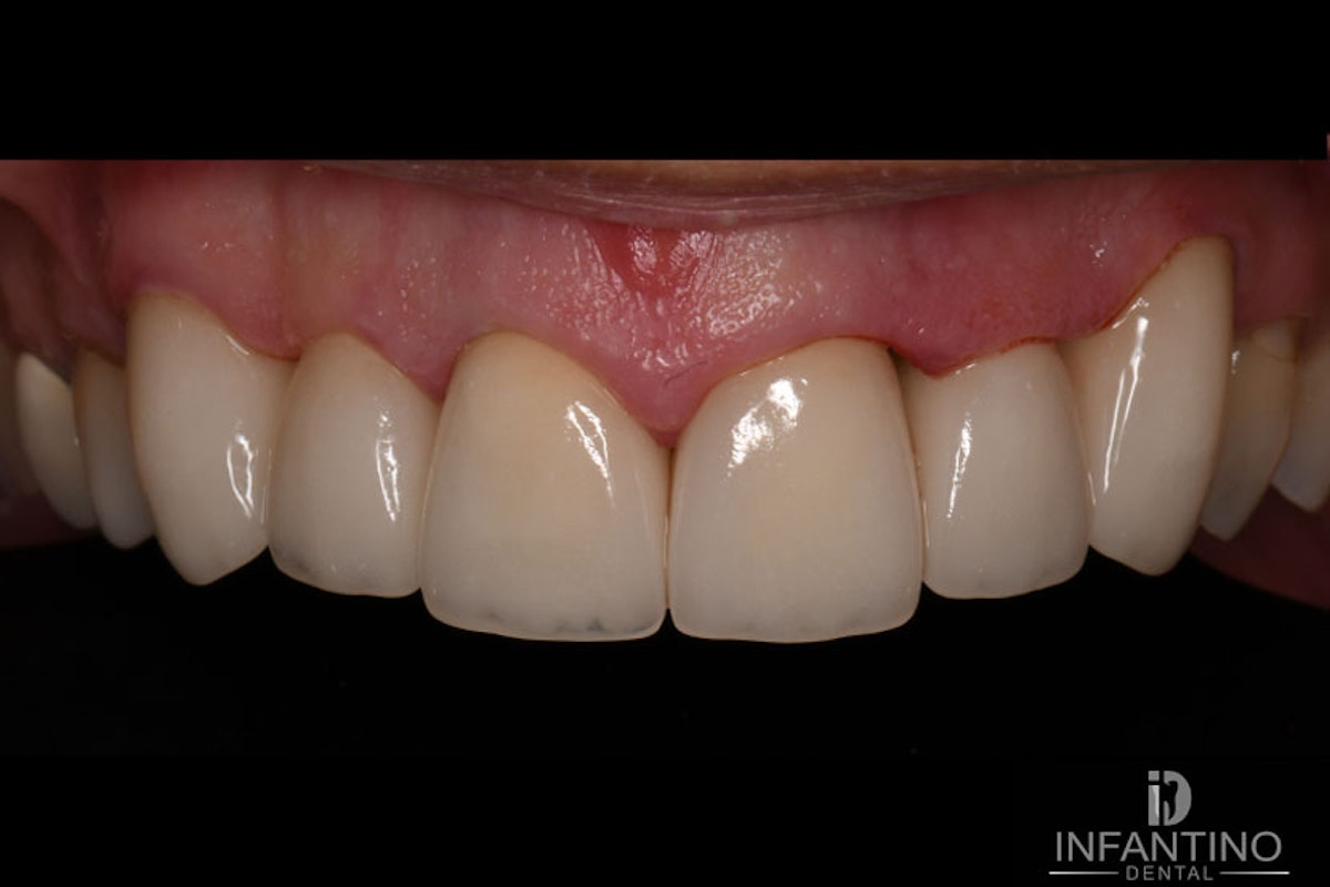 CF After Crowns