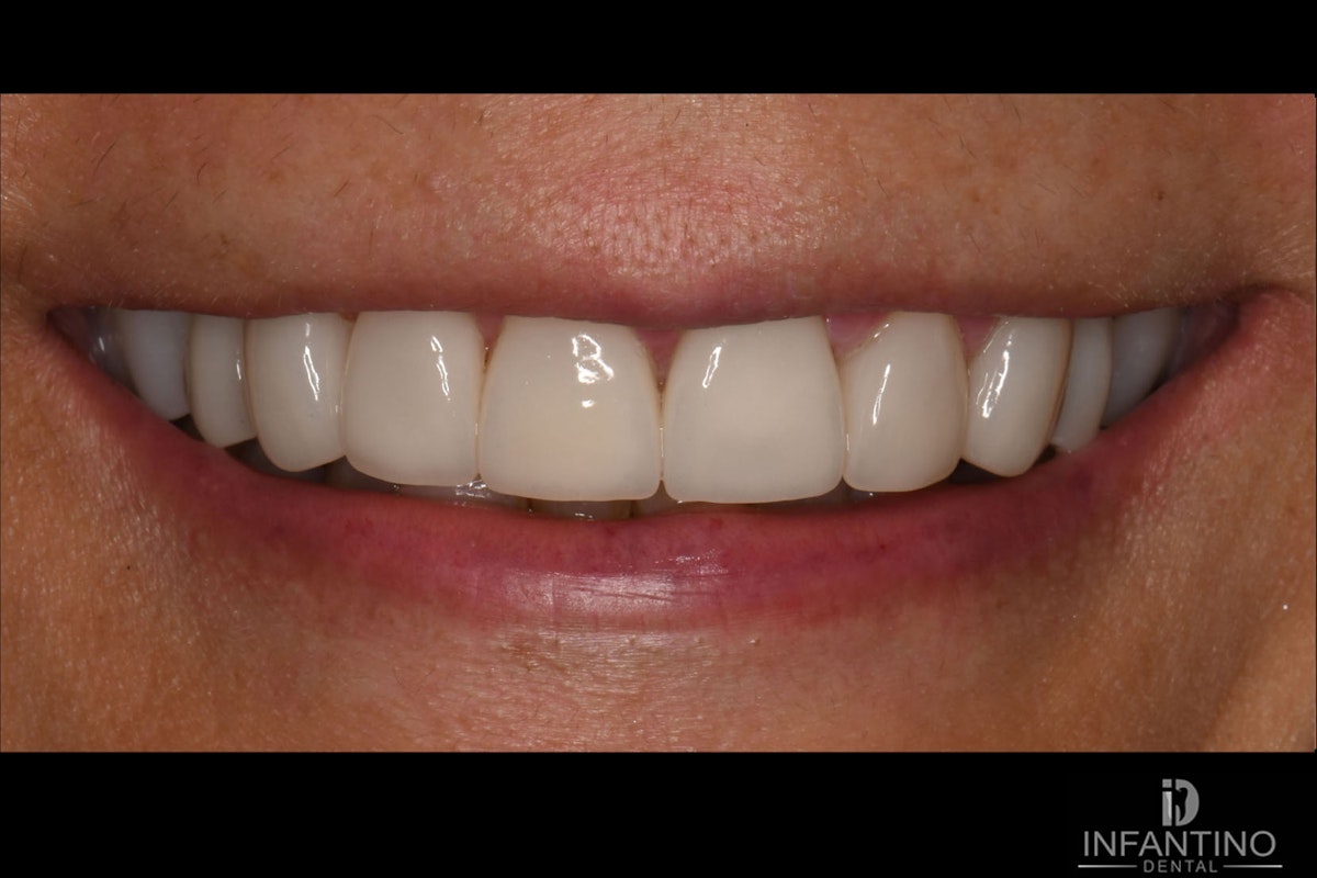 MB After veneers