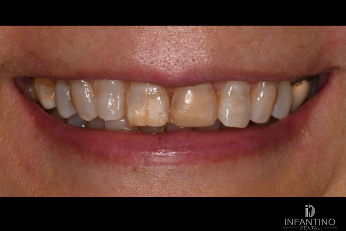 MB Before veneers