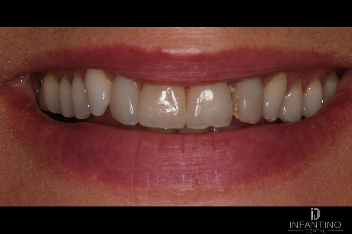 DE Before Veneers