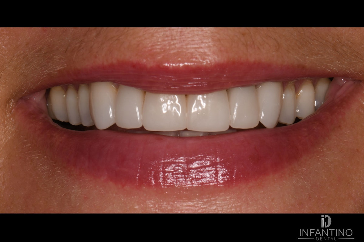 DE After Veneers