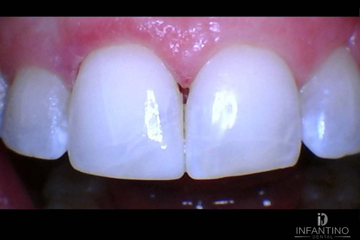 Composite bonding 8 after