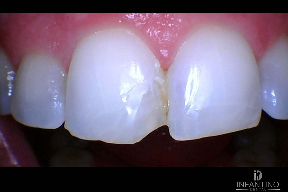Composite bonding 8 before