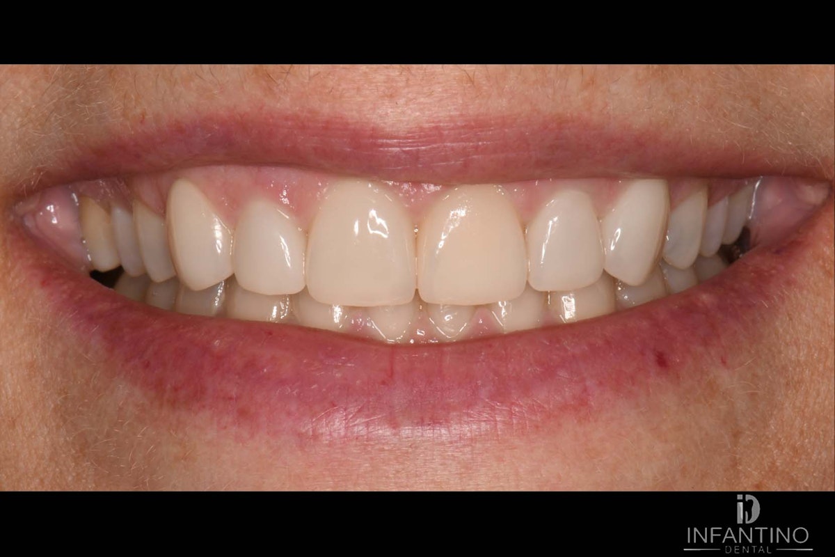 YC After veneers