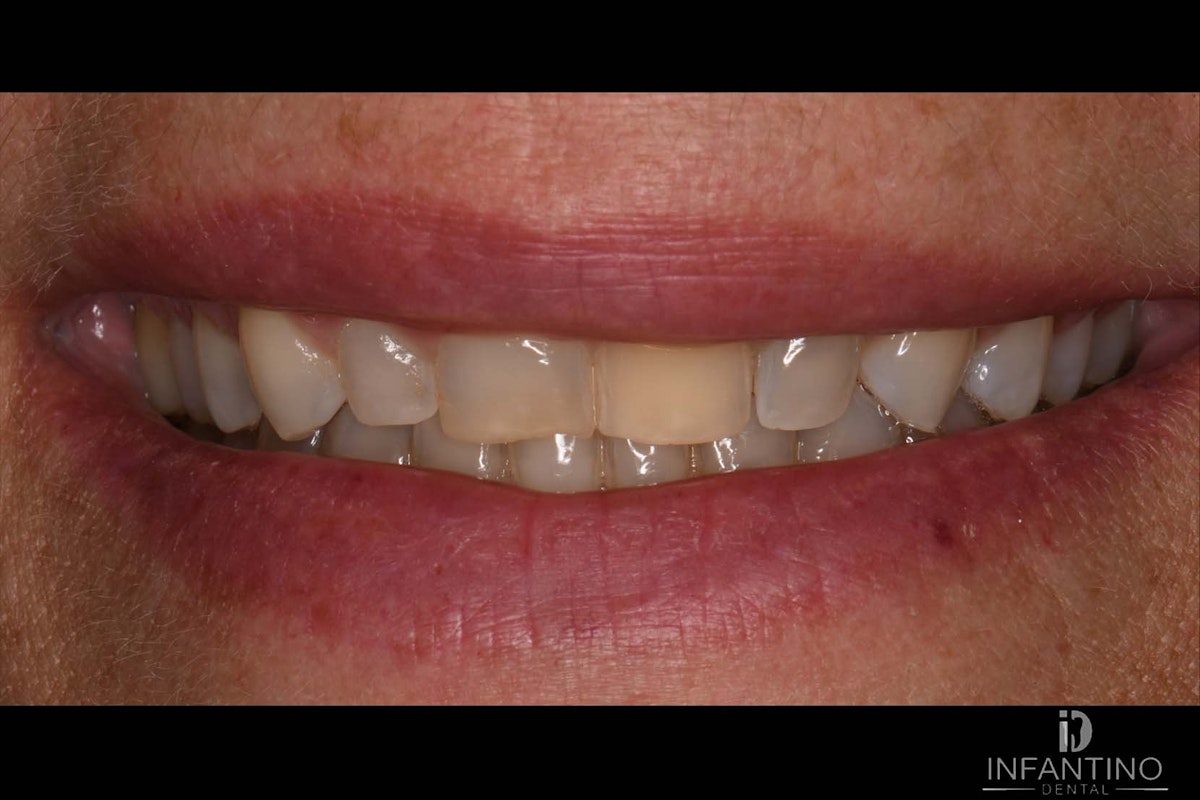 YC Before veneers