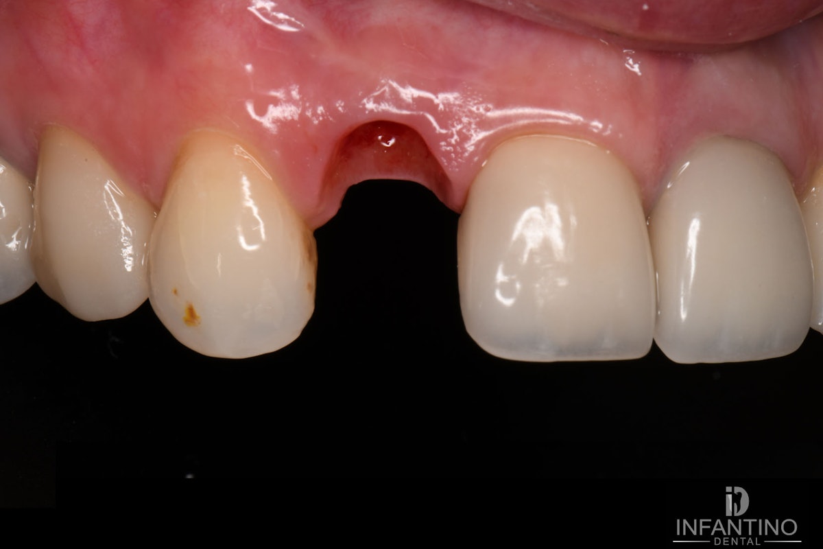 Single implant before