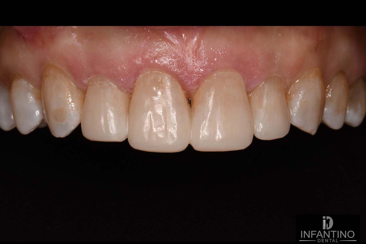 Comp Veneers After
