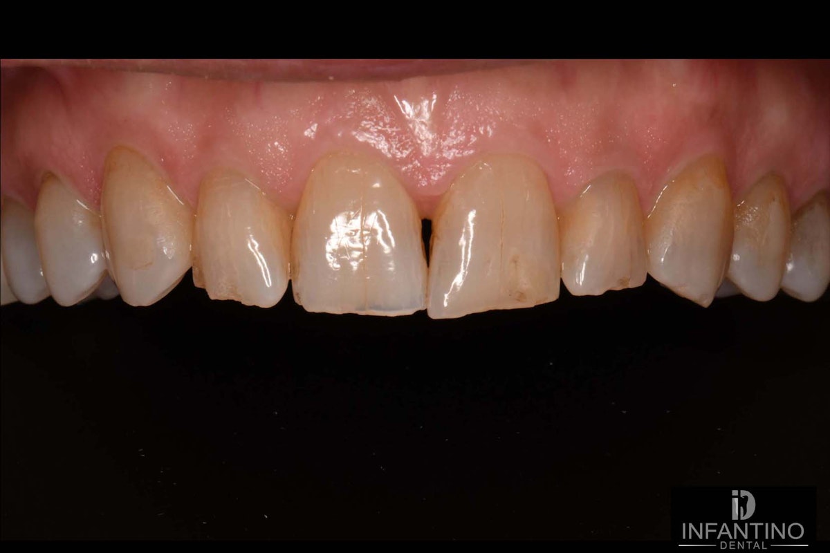 Comp Veneers Before