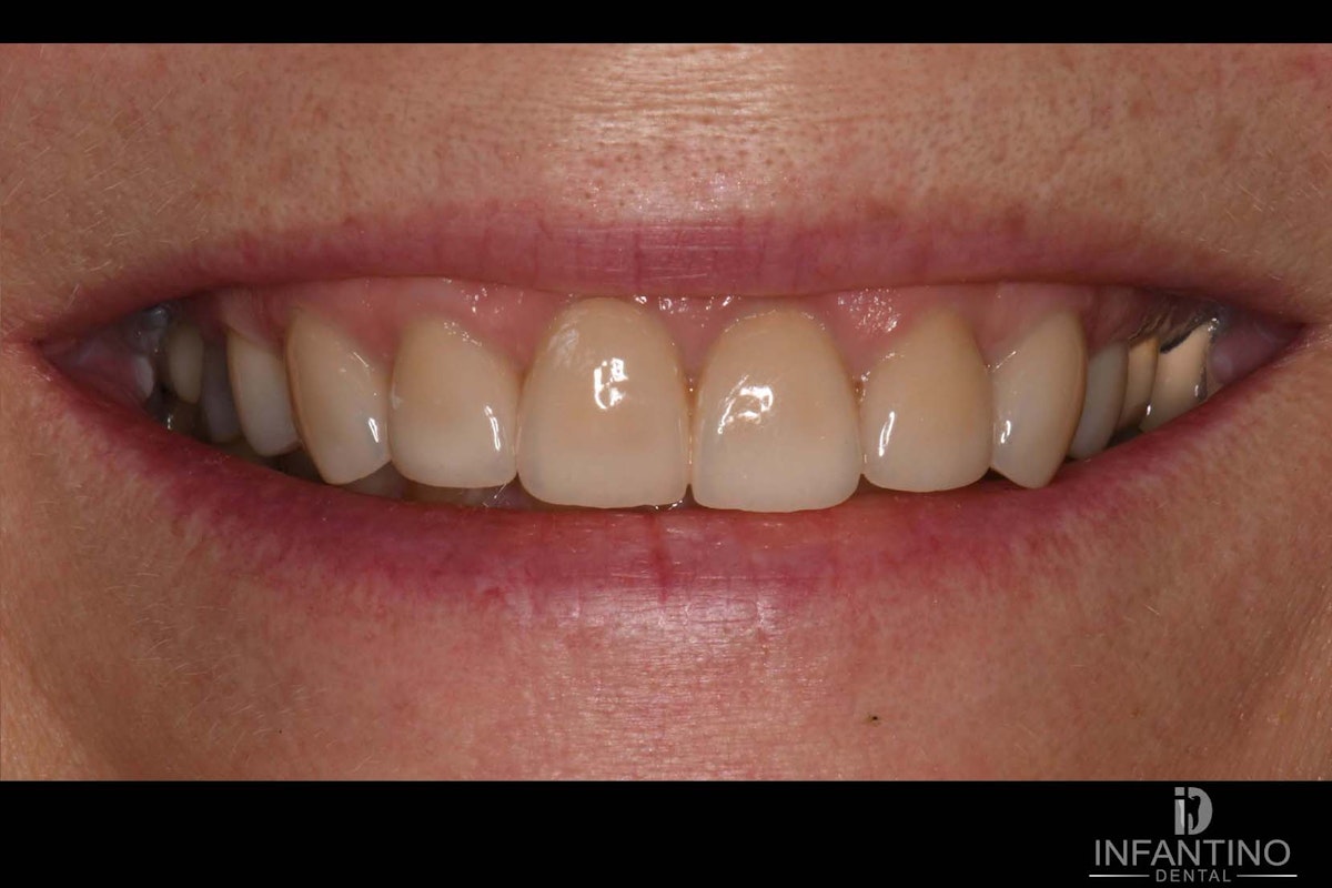 CB After veneers