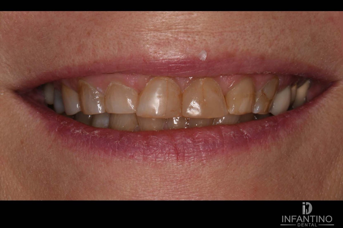 CB Before veneers