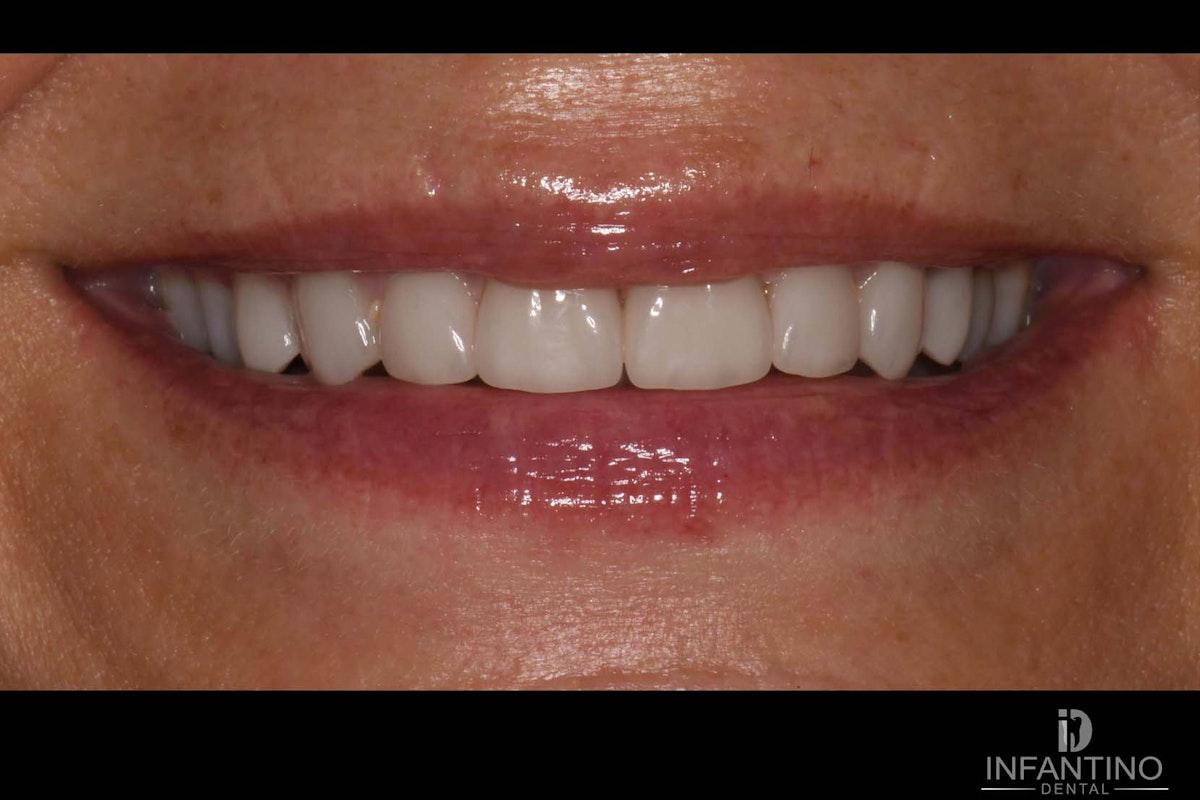CJ After veneers