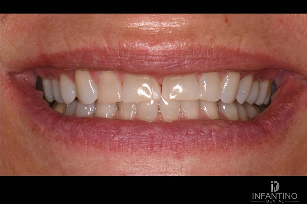 CJ Before veneers