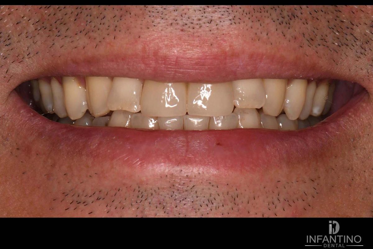 After Implant and crown