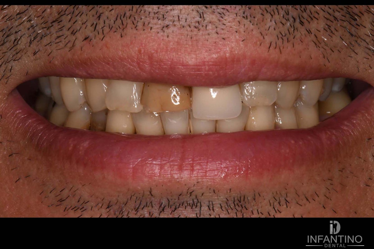 Before Implant and crown