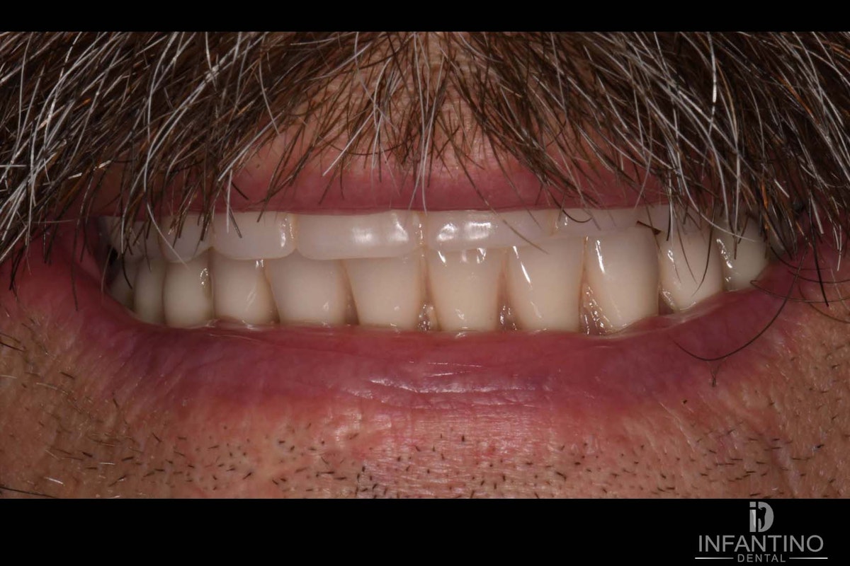 Max Man hybrid After