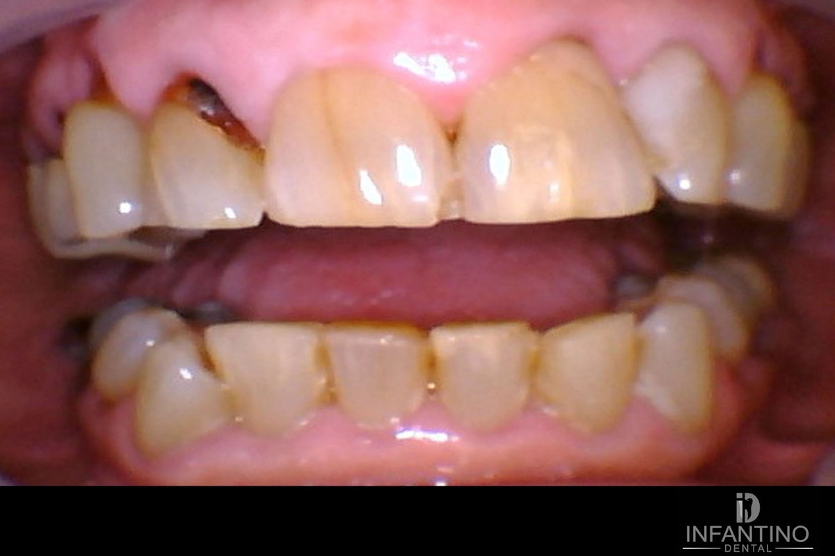 Max hybrid 2 before