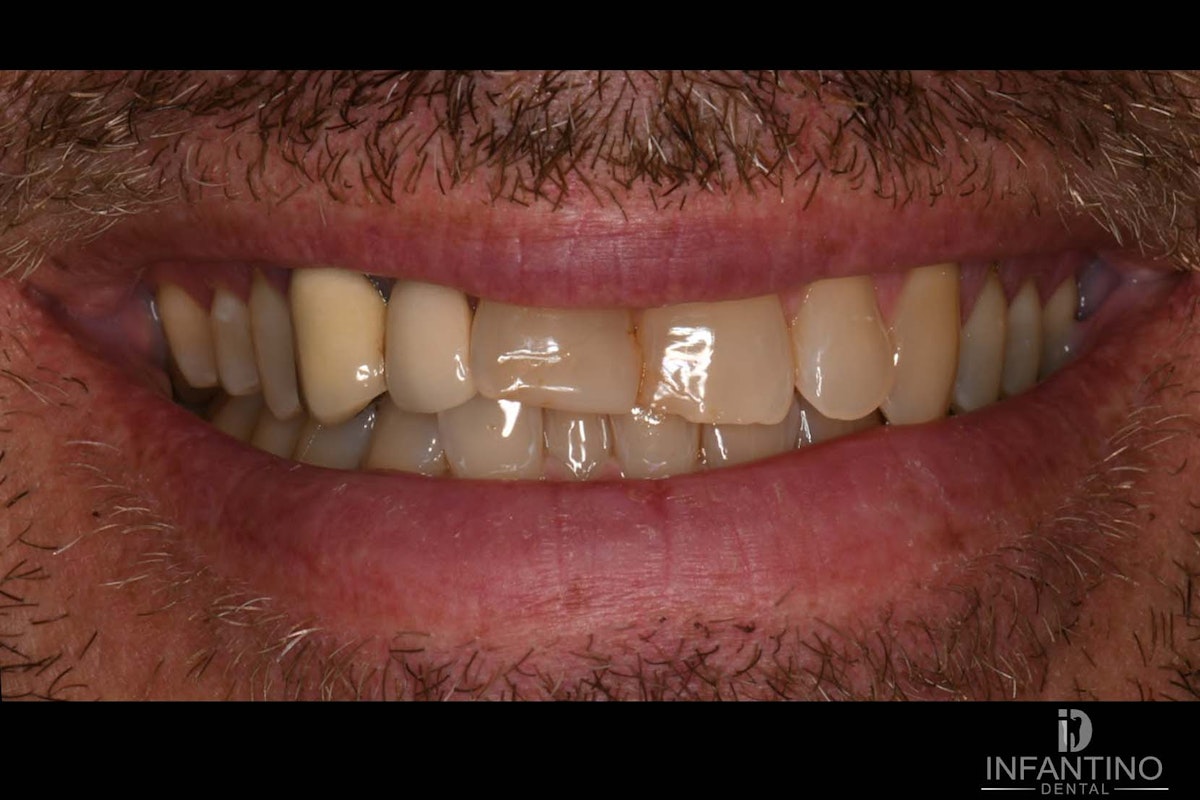 MS Bridge and crowns before