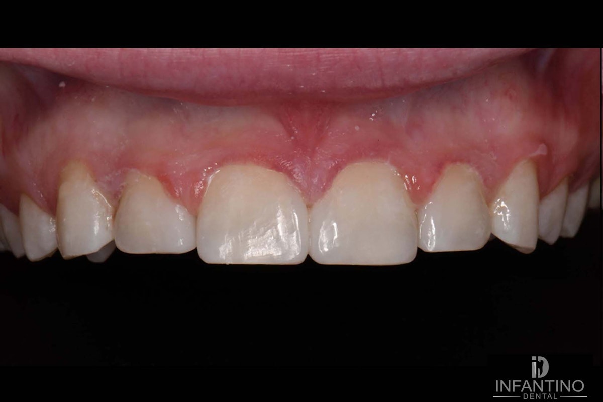 Diastema Closure After