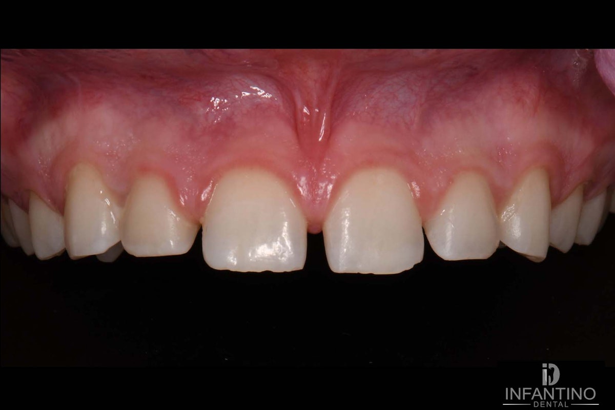 Diastema Closure Before