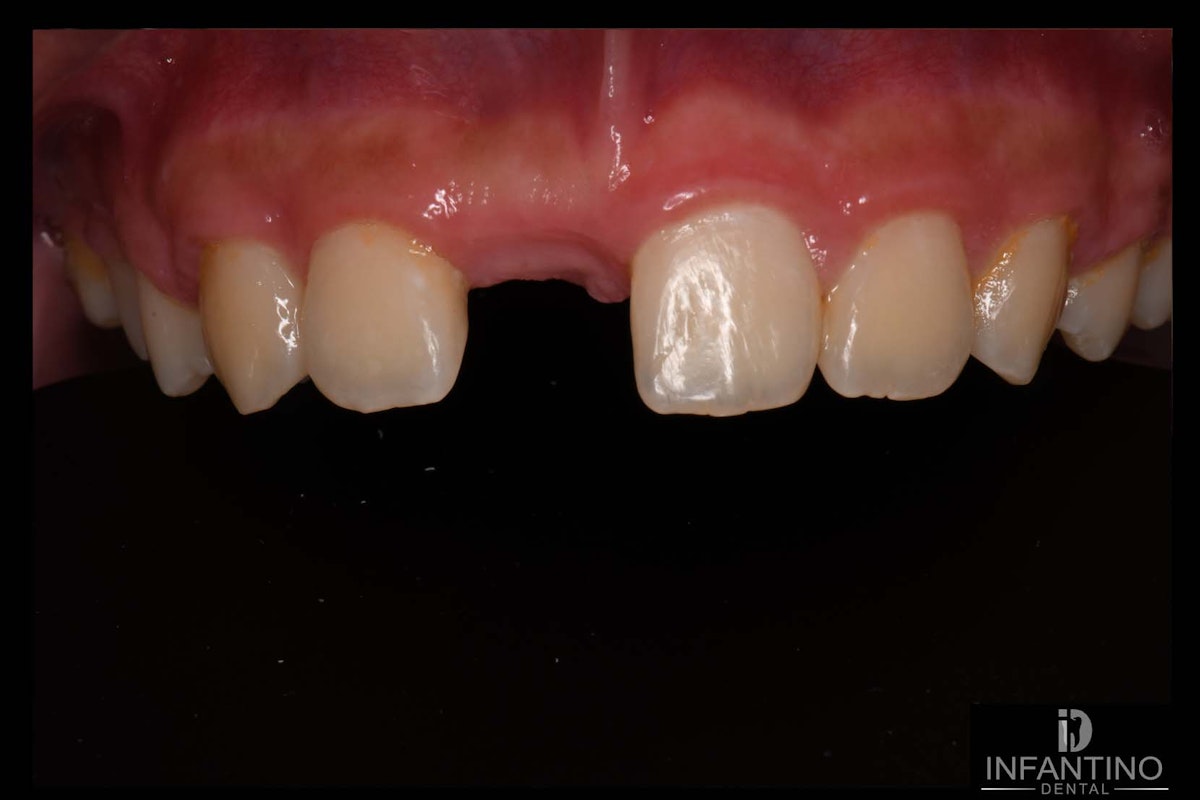BT Maryland Bridge before
