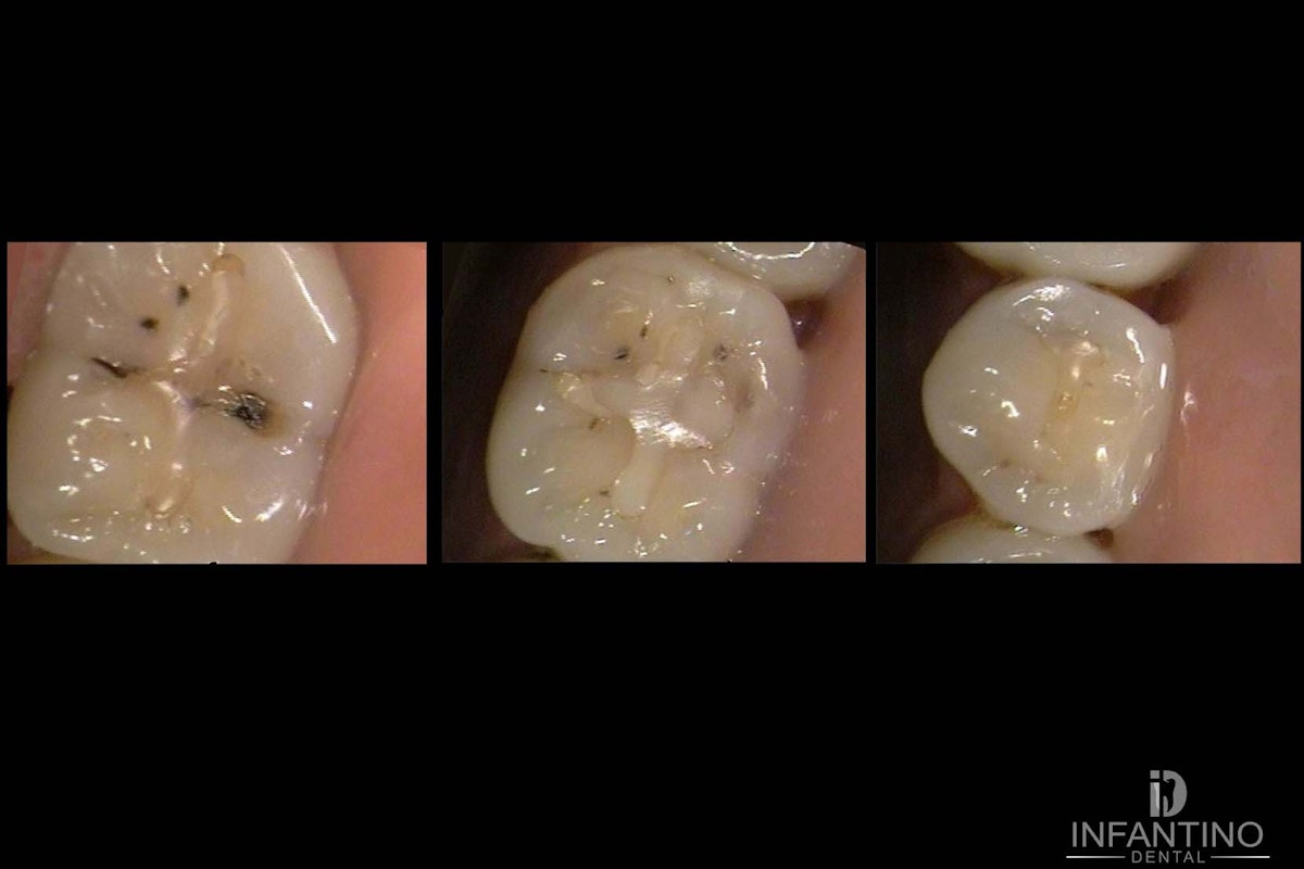 Composite fillings before