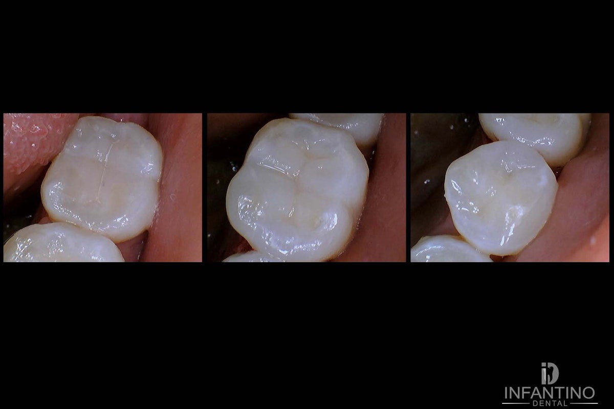 Composite fillings after