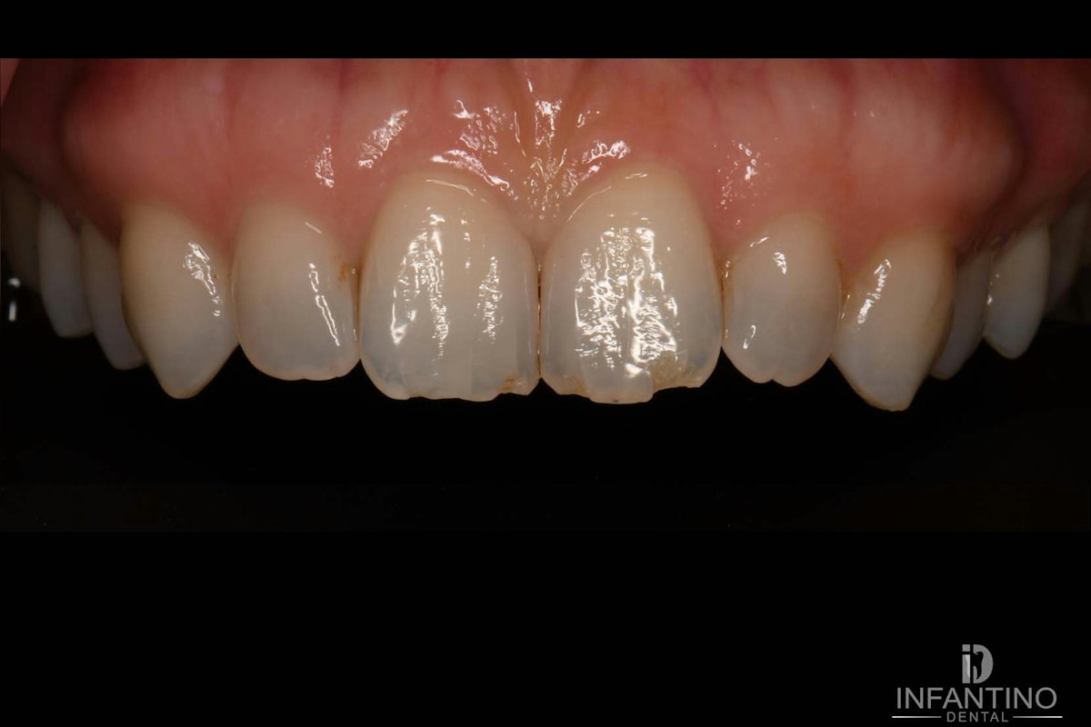 8 and 9 composite bonding before