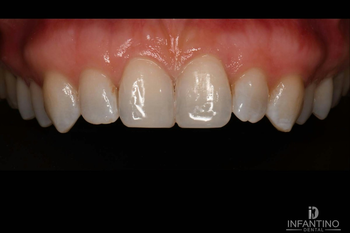 8 and 9 composite bonding after
