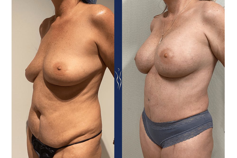 48 year old mommy makeover with tummy tuck and breast augmentation