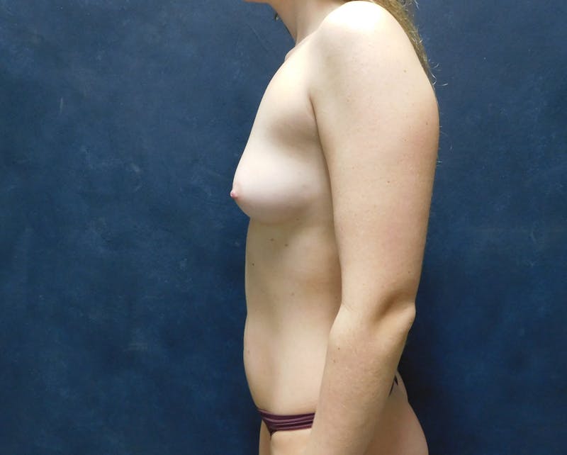 Breast Augmentation Before & After Gallery - Patient 176275 - Image 11