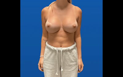 Breast Augmentation Before & After Gallery - Patient 163352 - Image 2