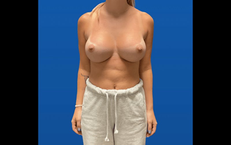 Breast Augmentation Before & After Gallery - Patient 163352 - Image 2