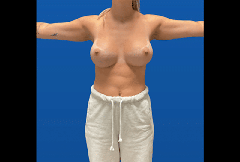 Breast Augmentation Before & After Gallery - Patient 163352 - Image 4